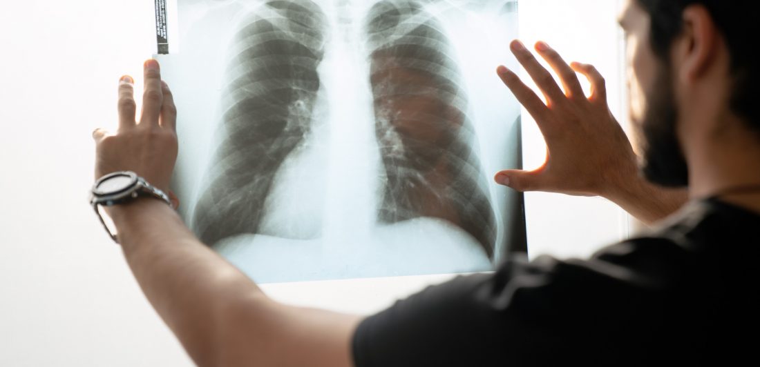 popcorn-lung Image of person viewing a chest x-ray