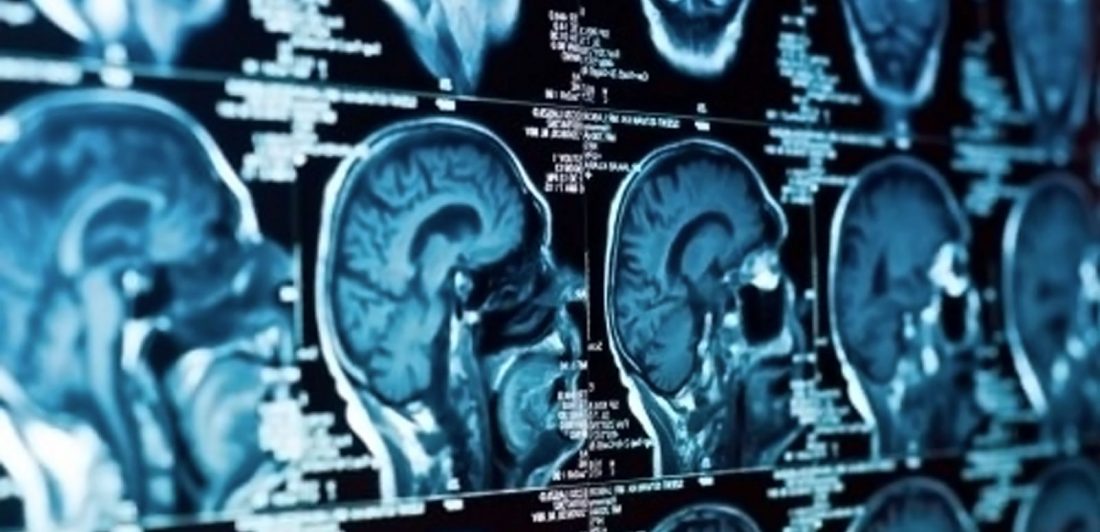 post-brain-injury-care Image of brain scan film